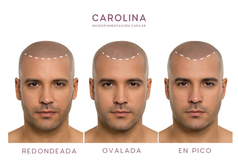 micro capilar linea