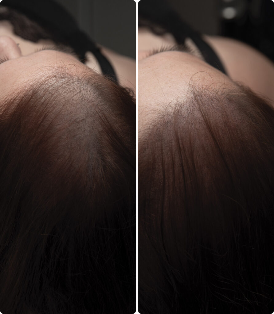 ANTES DESPUES micropigmentacion capilar facial mujer Carolinadelarosa