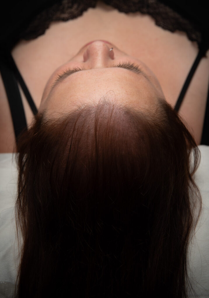 DESPUES micropigmentacion capilar facial mujer web 2