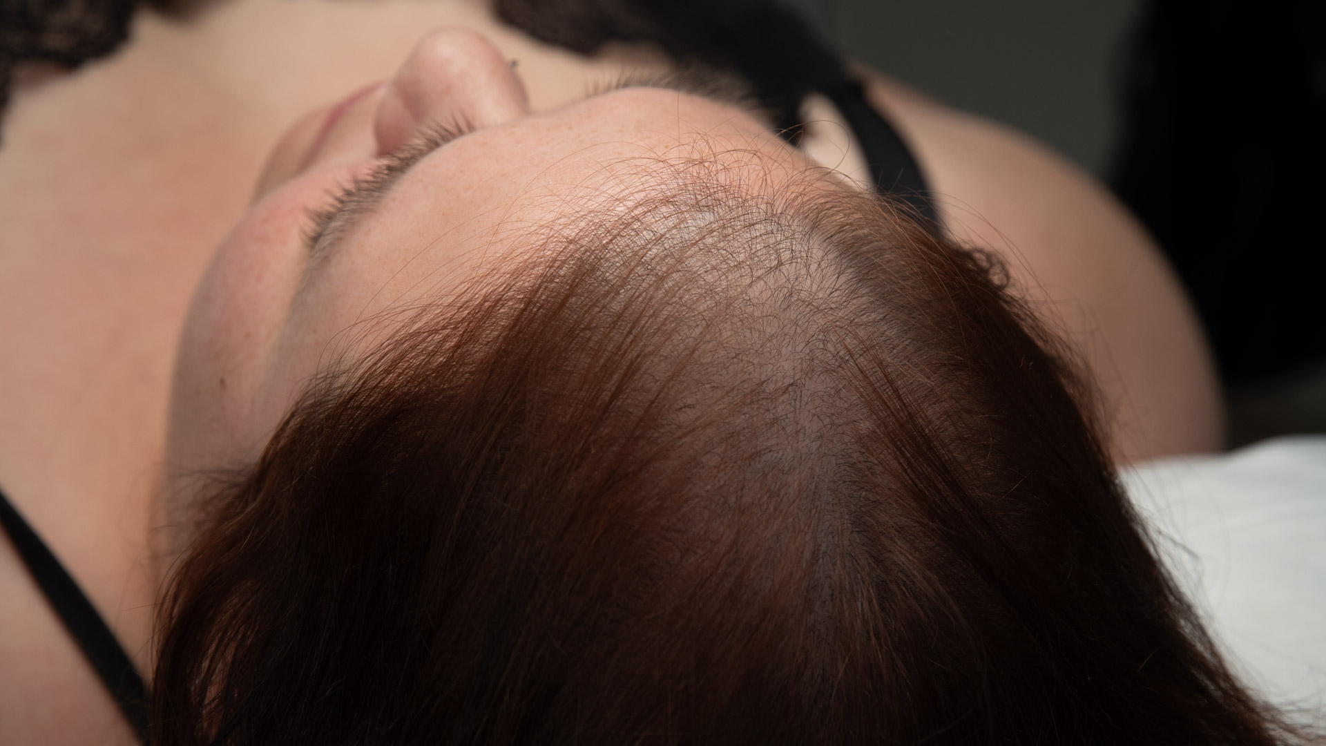 Micropigmentación capilar efecto densidad mujer antes de la realización