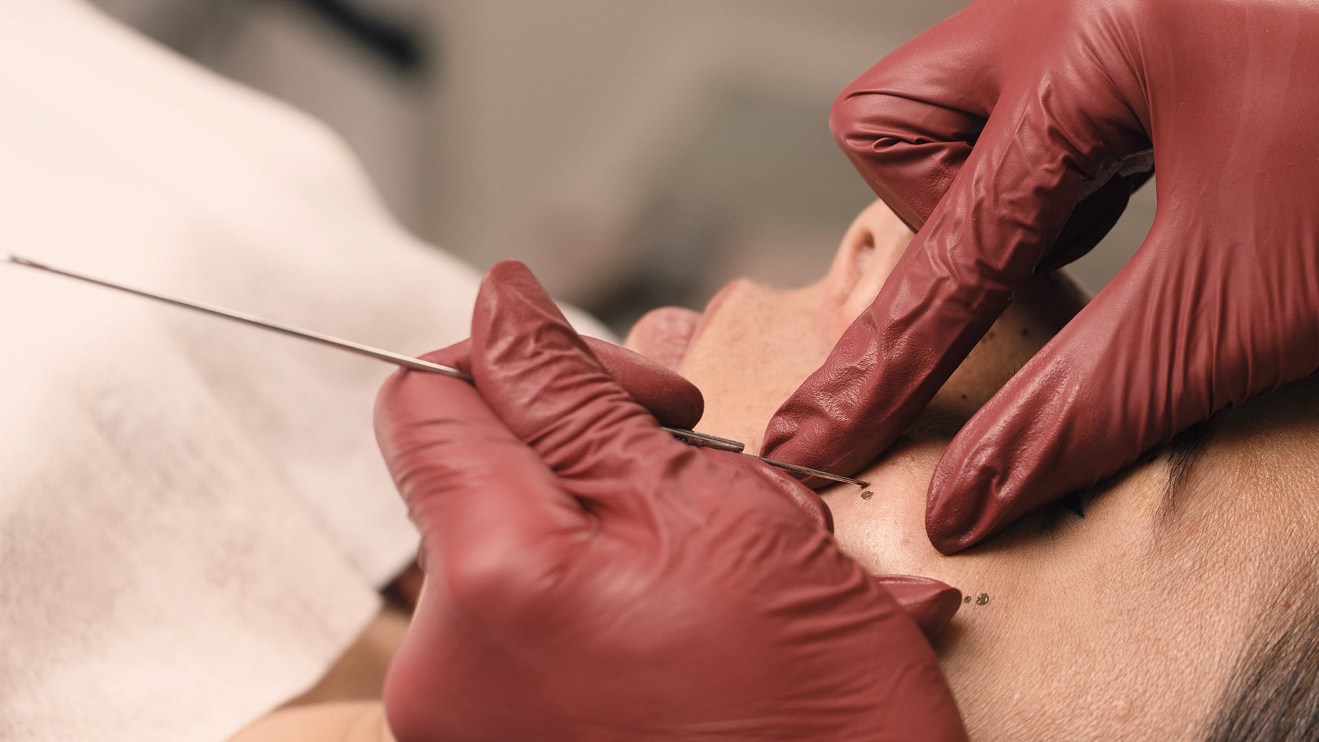 micropigmentacion pecas portad3