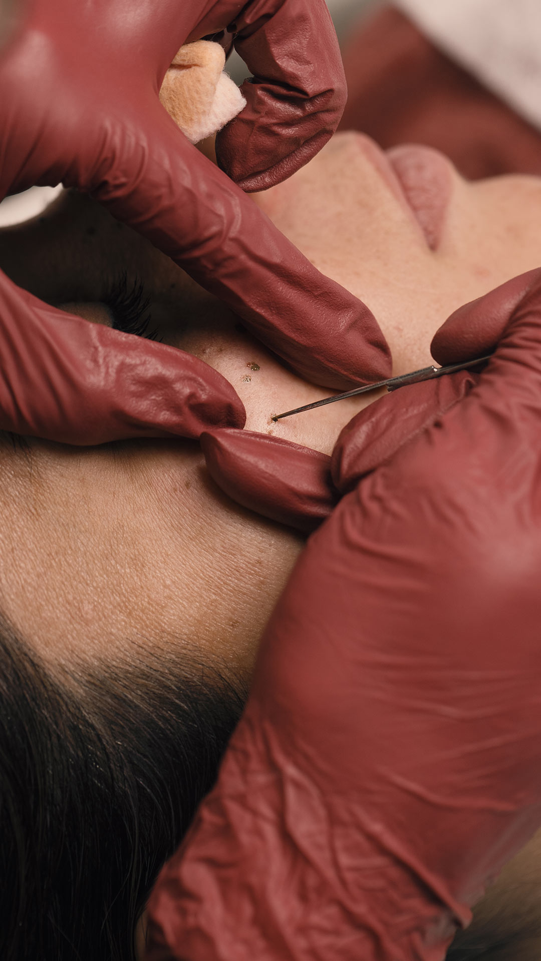 micropigmentacion pecas portad4